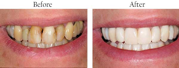 Before and After Teeth Whitening in Farmington