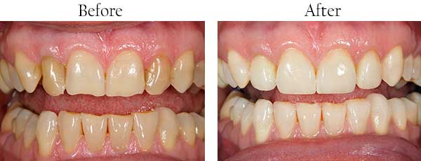 Before and After Invisalign in Farmington