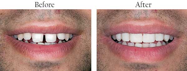 Before and After Dental Implants in Farmington