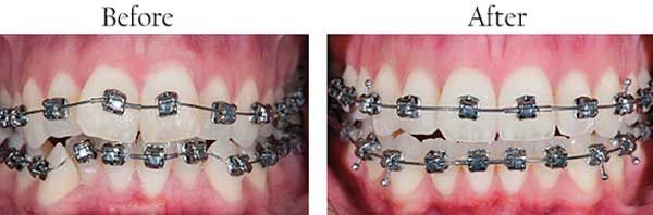 Before and After Braces in Farmington