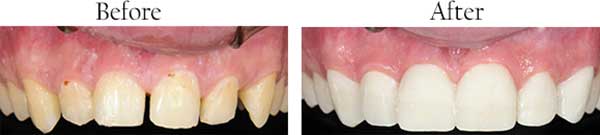 Farmington Before and After Invisalign