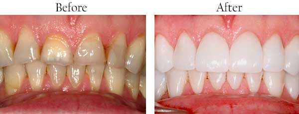 Farmington Before and After Dental Implants
