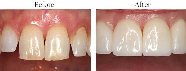 Farmington Before and After Teeth Whitening