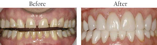 Farmington Before and After Invisalign